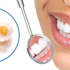 dental-crowns Dental Crowns in Turkey