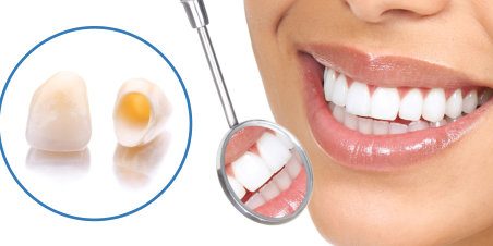 dental-crowns Dental Crowns in Turkey