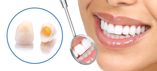 Dental Crowns in Turkey