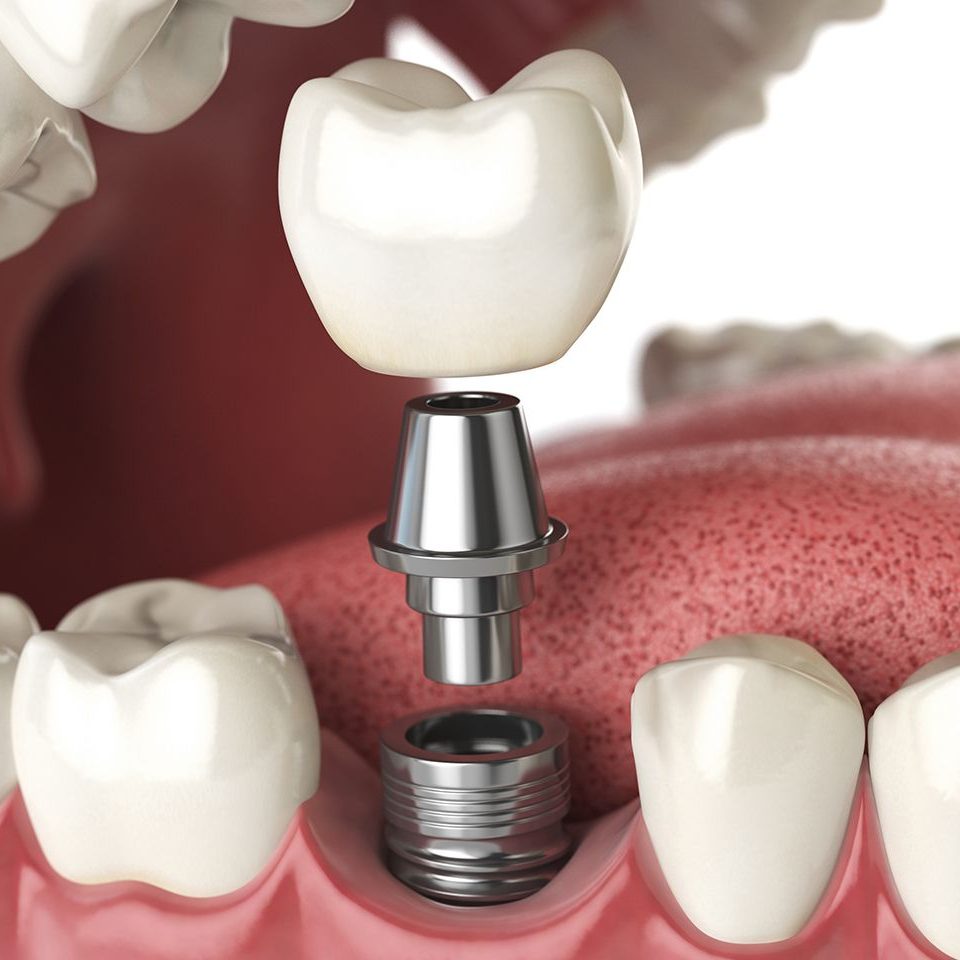 Dental implants in Turkey