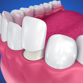 Veneers in Turkey Veneers in Turkey