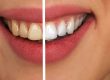 Teeth Whitening Turkey