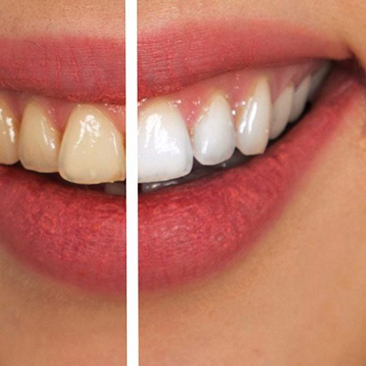 teethwhiteningturkey Teeth Whitening Turkey