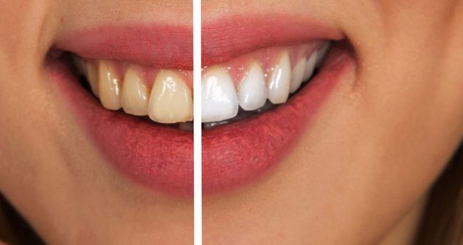 Teeth Whitening Turkey