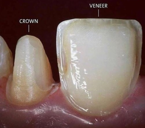 Shaved down teeth