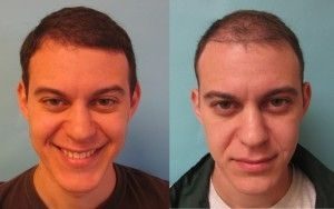 Hair Restoration in Turkey