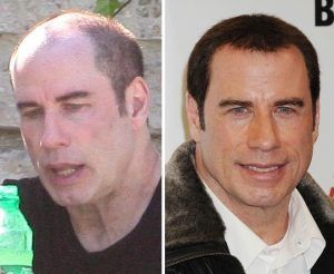 celebrity hair transplant before and after