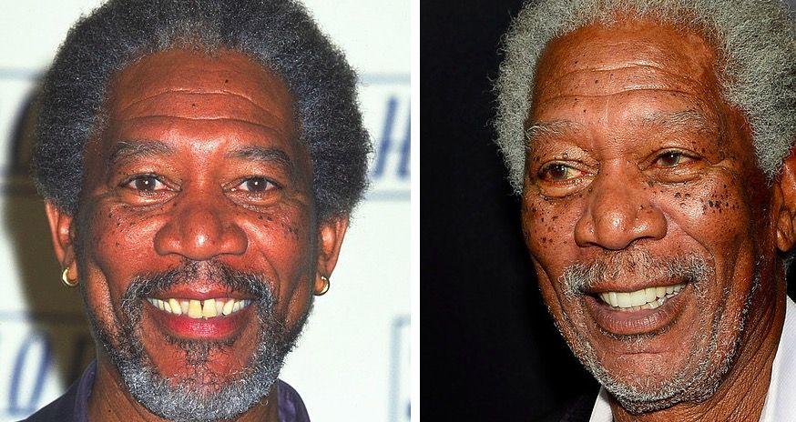 Celebrity smile transformation