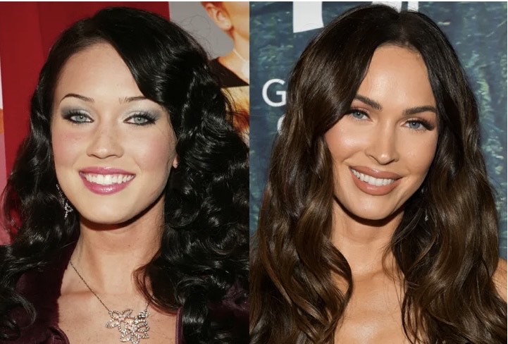 Celebrities Before And After Veneers