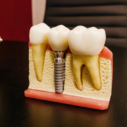 Full Mouth Dental Implants Turkey Package Deals