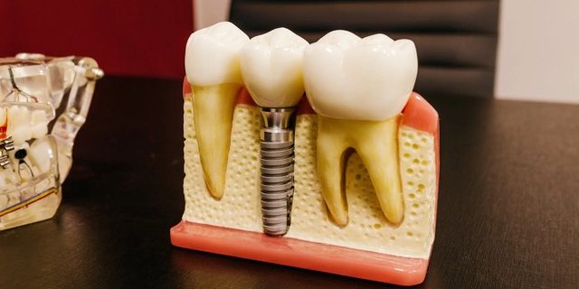 Full Mouth Dental Implants Turkey Package Deals Full Mouth Dental Implants Turkey Package Deals