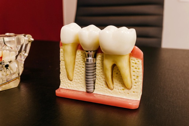 Full Mouth Dental Implants Turkey Package Deals Full Mouth Dental Implants Turkey Package Deals