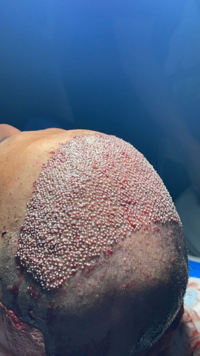 Hair Transplant istanbul