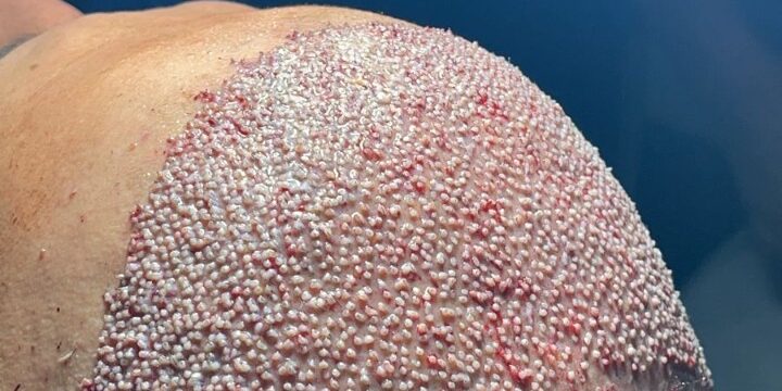 Hair Transplant istanbul