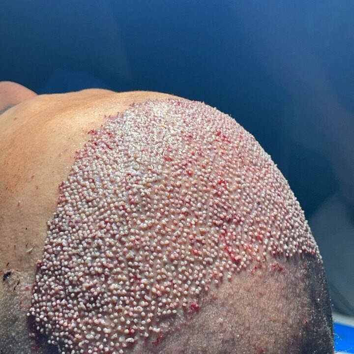 Hair-Transplant-istanbul Hair Transplant istanbul