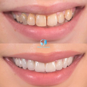 veneers before and after buck teeth