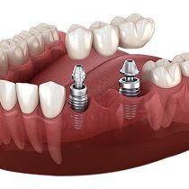 Dental Implant or Bridges