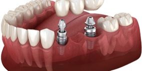 Dental Implant or Bridges