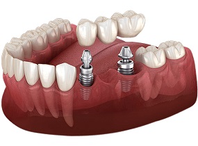 Dental Implant or Bridge